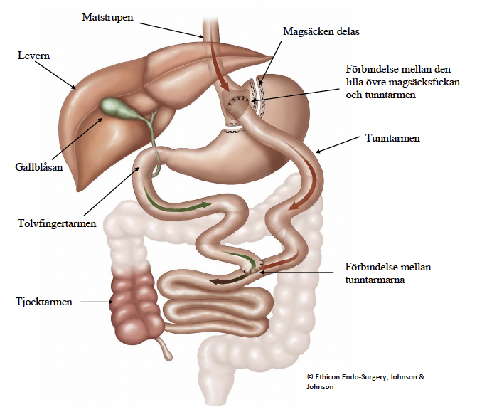 Illustration Gastric bypass.png